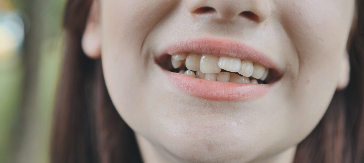 Dentes tortos
